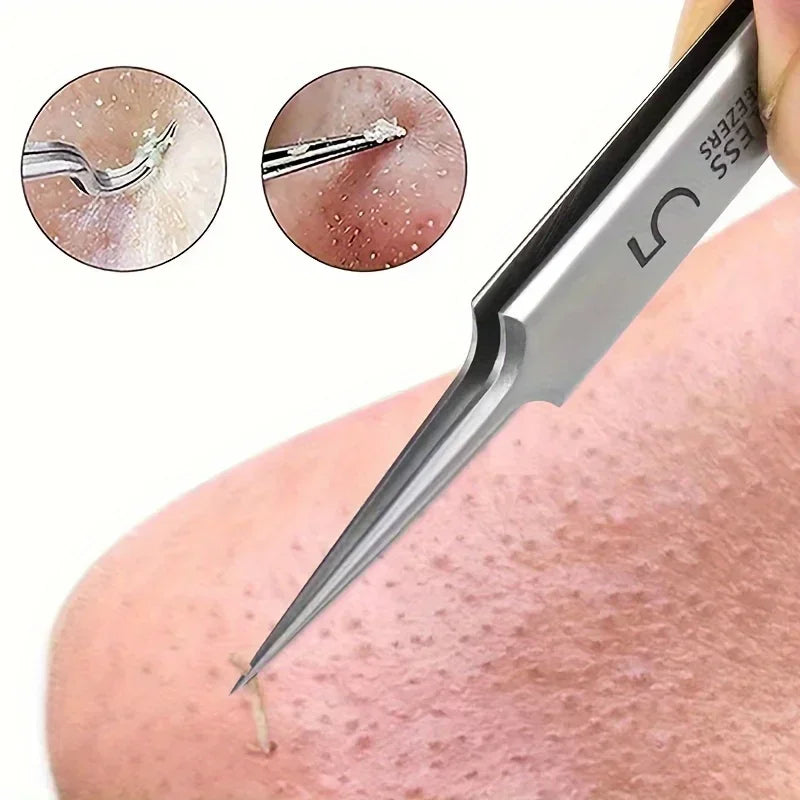 Blackhead &amp; Acne Tweezers - Precision Skin Care Tool for Facial Acne Removal