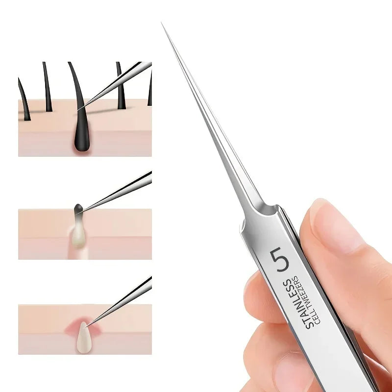 Blackhead &amp; Acne Tweezers - Precision Skin Care Tool for Facial Acne Removal